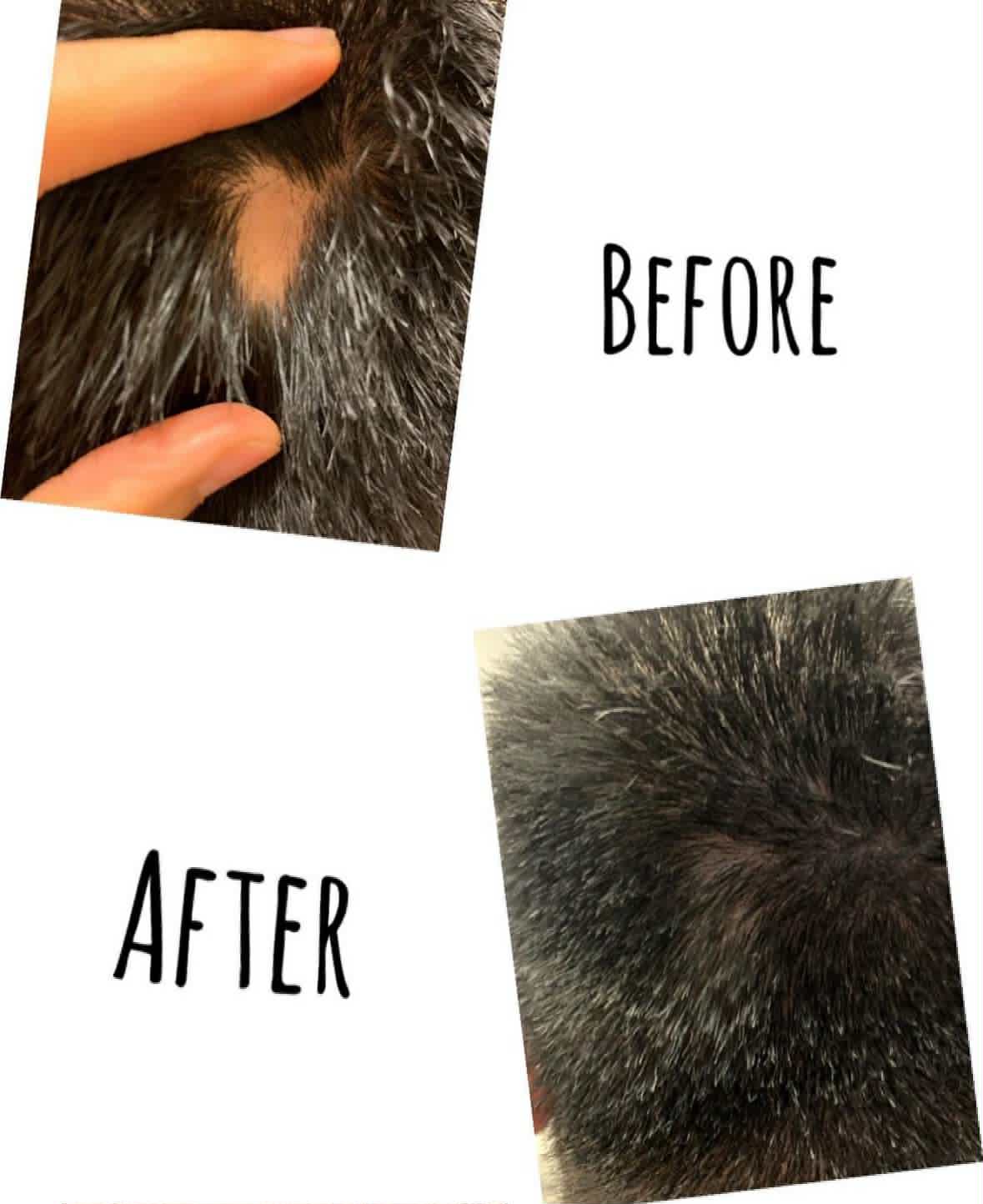 Alopecia treatment before and after results