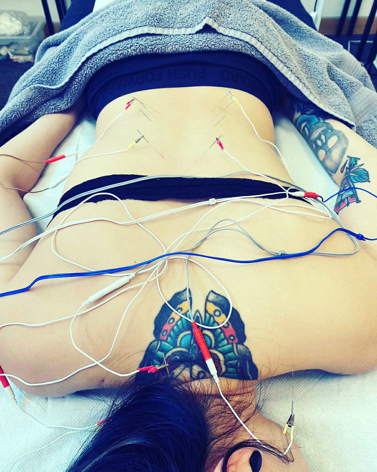 Modern acupuncture treatment