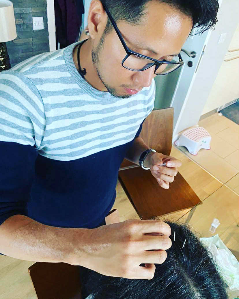 Acupuncture treatment on head